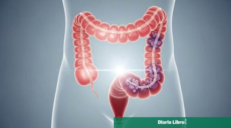 Salud Pública insta a mayores de 45 a chequeos de cáncer de colon