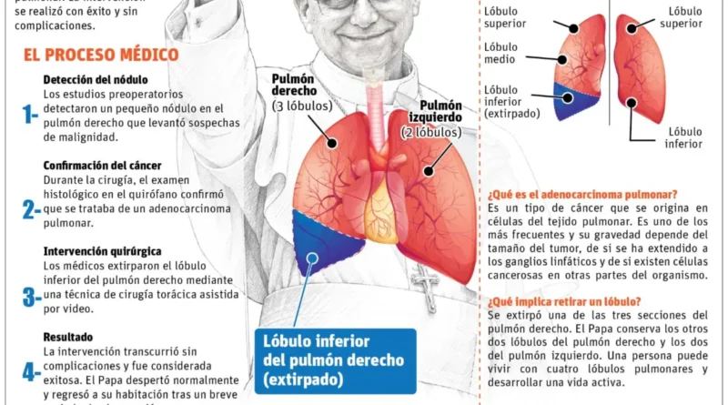 Fue exitosa operación al Papa sobre un cáncer en el pulmón